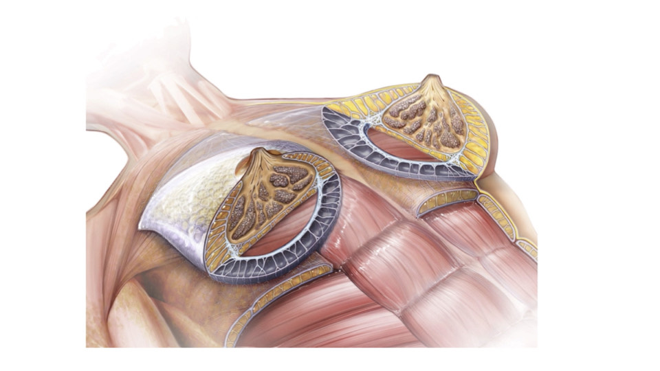 Breast Preservation Surgery Overview slide | Beverly Hills Plastic Surgery