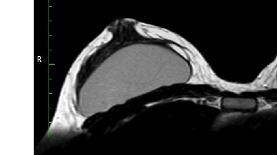 Breast Preservation Surgery Overview slide | Beverly Hills Plastic Surgery