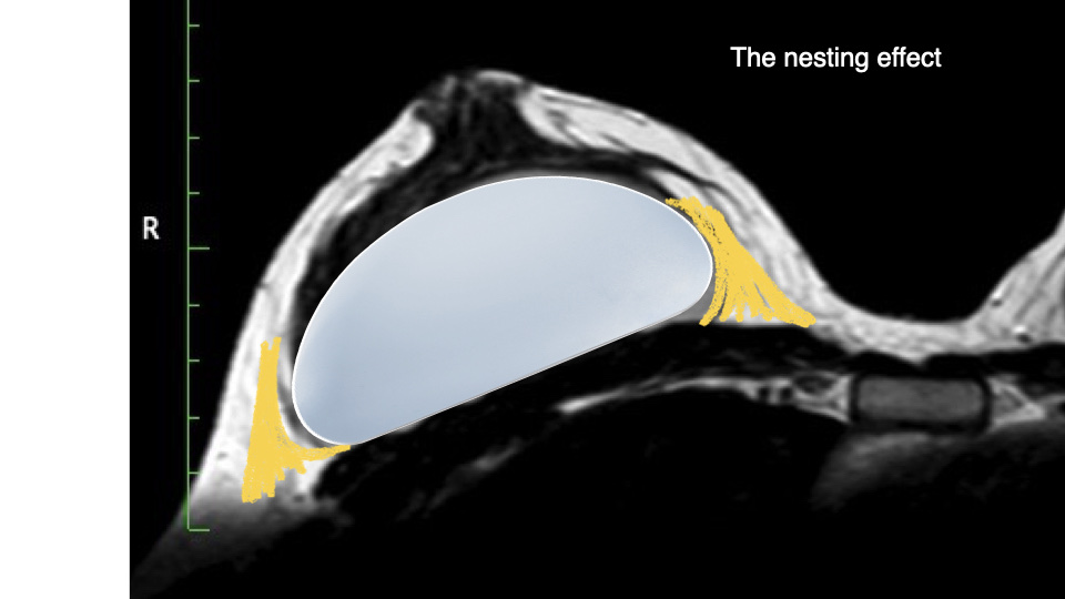 Breast Preservation Surgery Overview slide | Beverly Hills Plastic Surgery